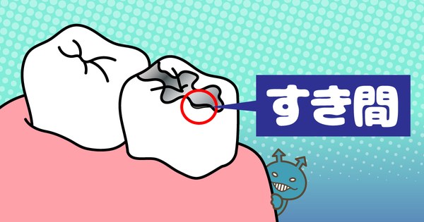 歯と修復物の間にできるすき間